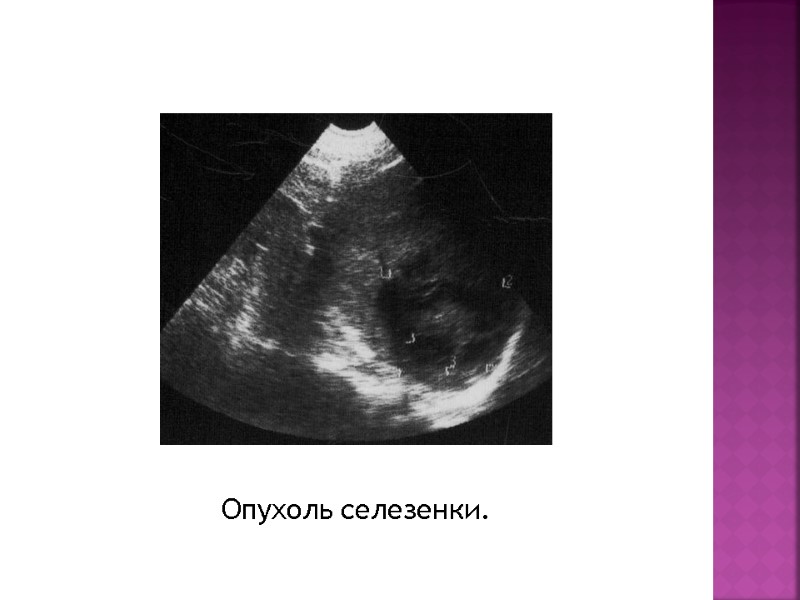 Опухоль селезенки.